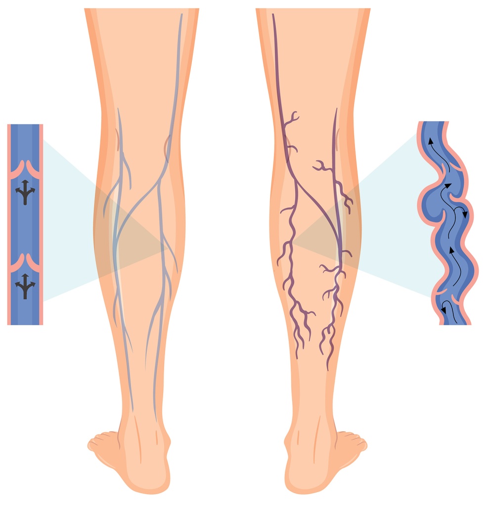 Do Dilated Leg Veins have any Adverse Effects on the Body ...