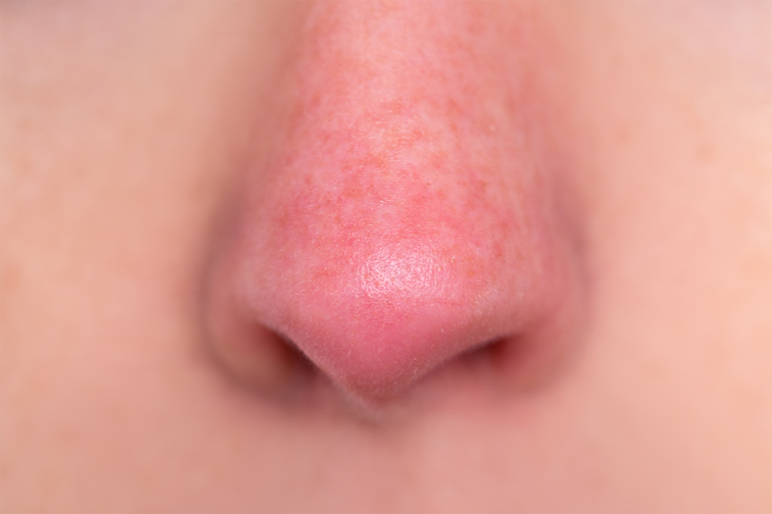 How to manage your Red Noses Skincentral, Dermatology, Aesthetics and