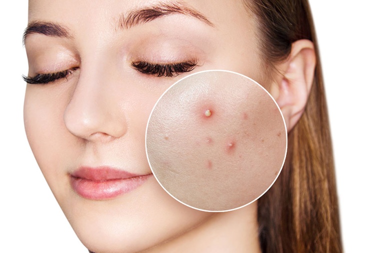 暗疮与粉刺：指南与建议 如何有效办别及治疗 - Skincentral